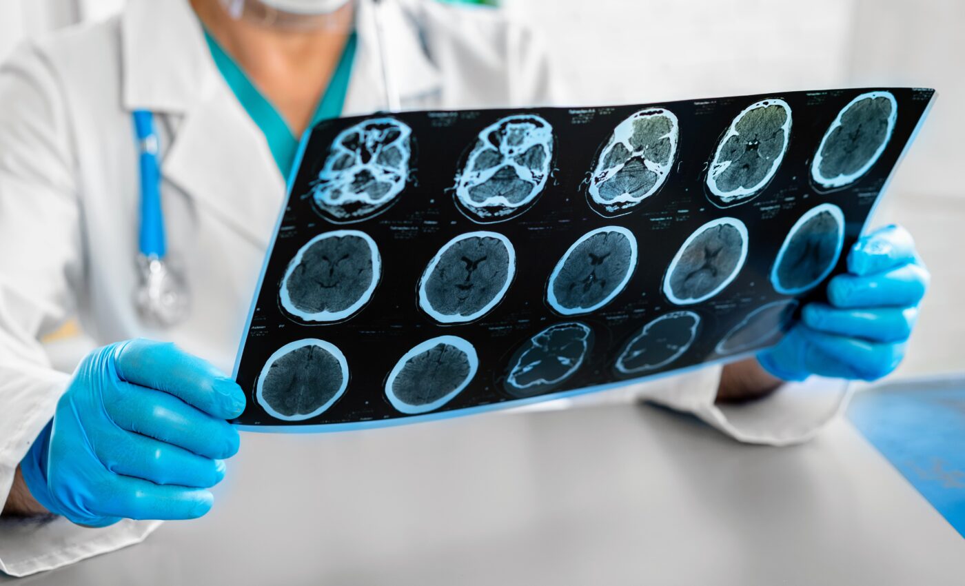 Long-COVID brain changes detected by advanced MRI technology