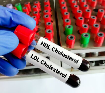 Blood,Samples,For,Hdl,Cholesterol,(good,Cholesterol),And,Ldl,Cholesterol