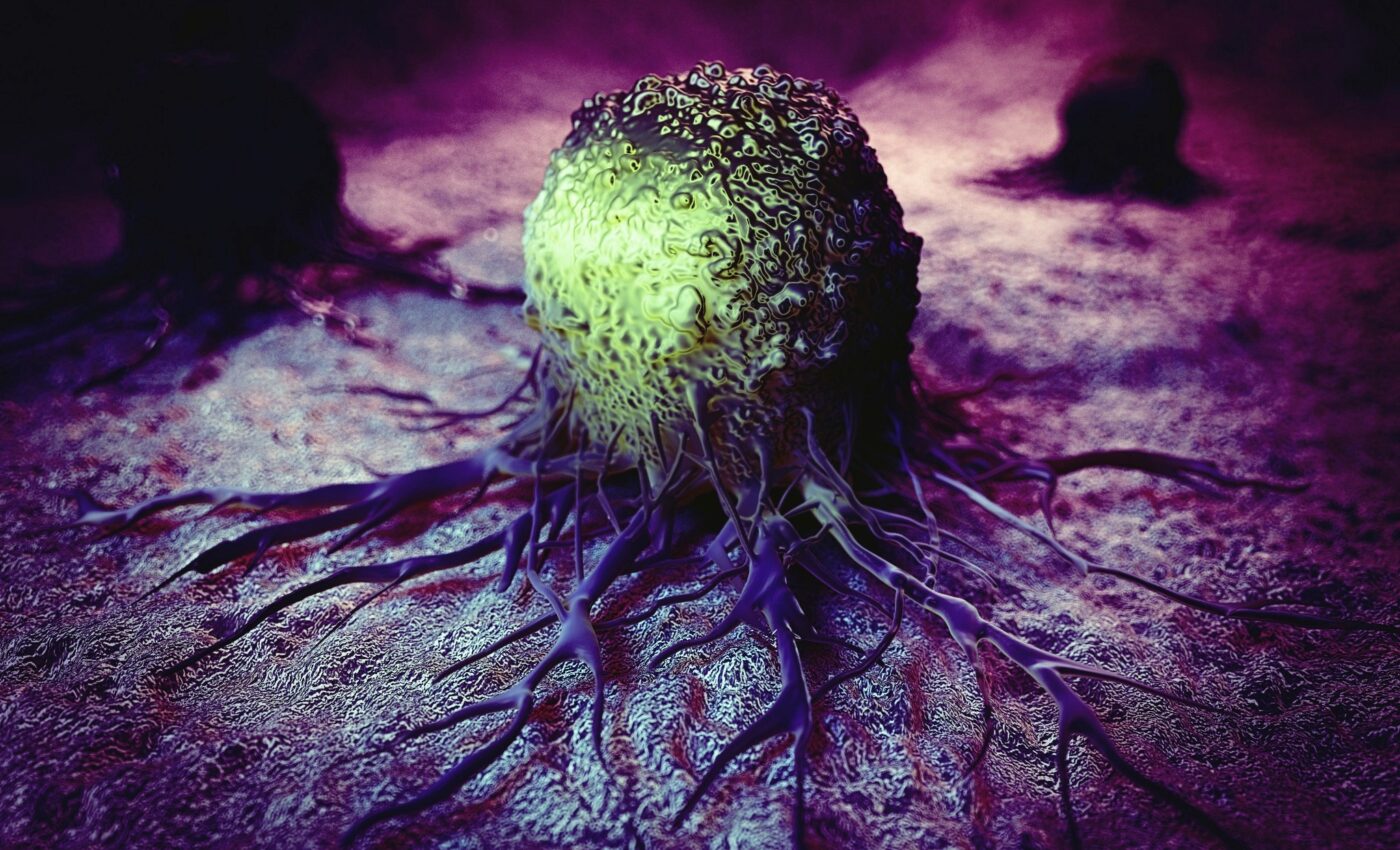 Gut bacteria linked to younger colon cancer patients