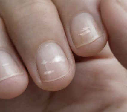 2024/12/stripes-on-nails-meaning-causes.jpg