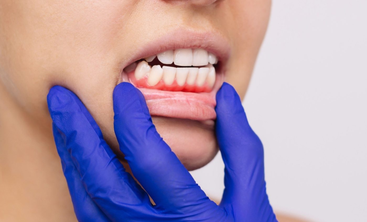 Plaque in orbit: Gum disease gets worse in space