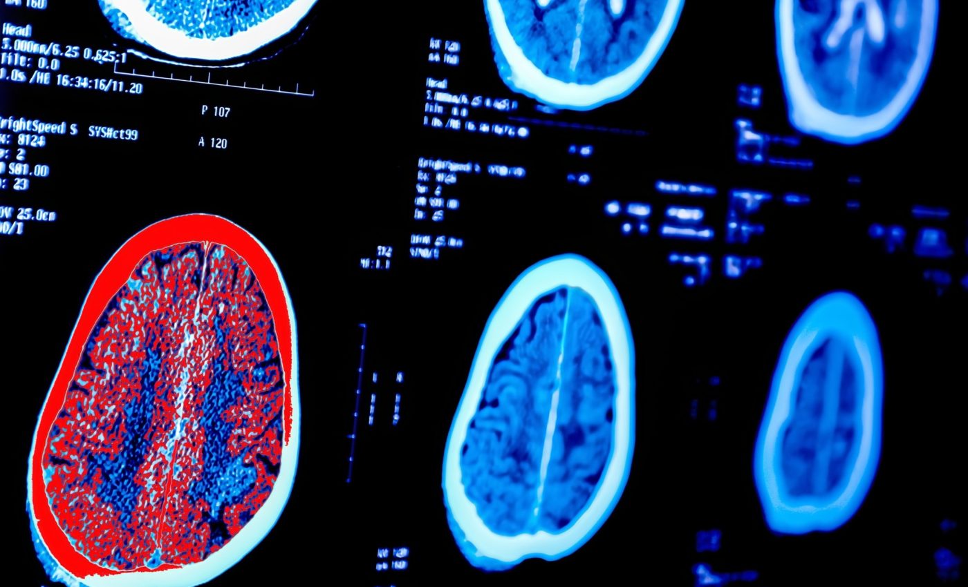 Your brain’s age might be older than your body, creating a "brain age gap"