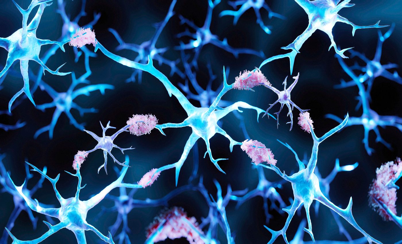 Youngest person to ever get Alzheimer’s disease has given scientists new clues to find a cure