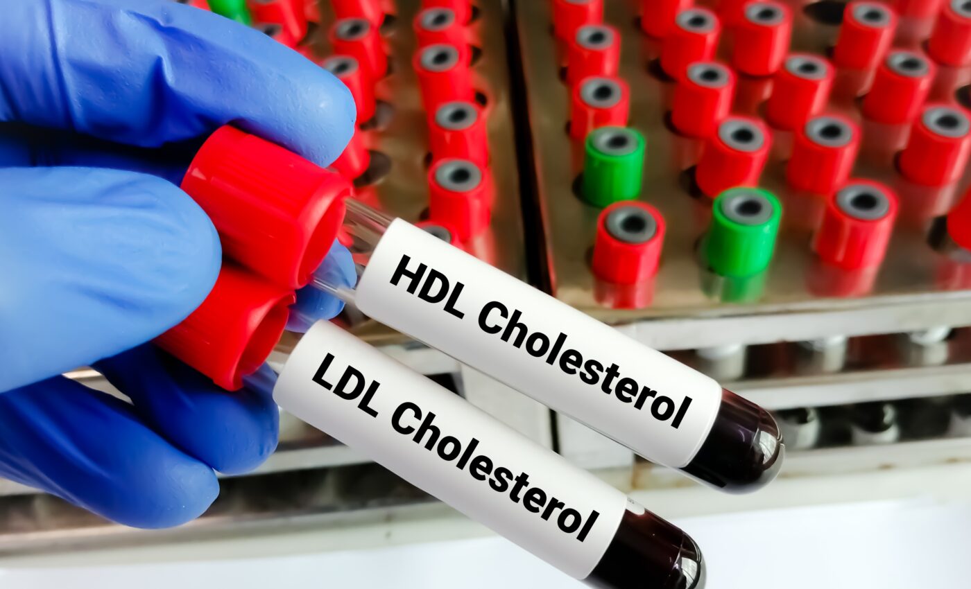 “Good” cholesterol may increase the risk of dementia