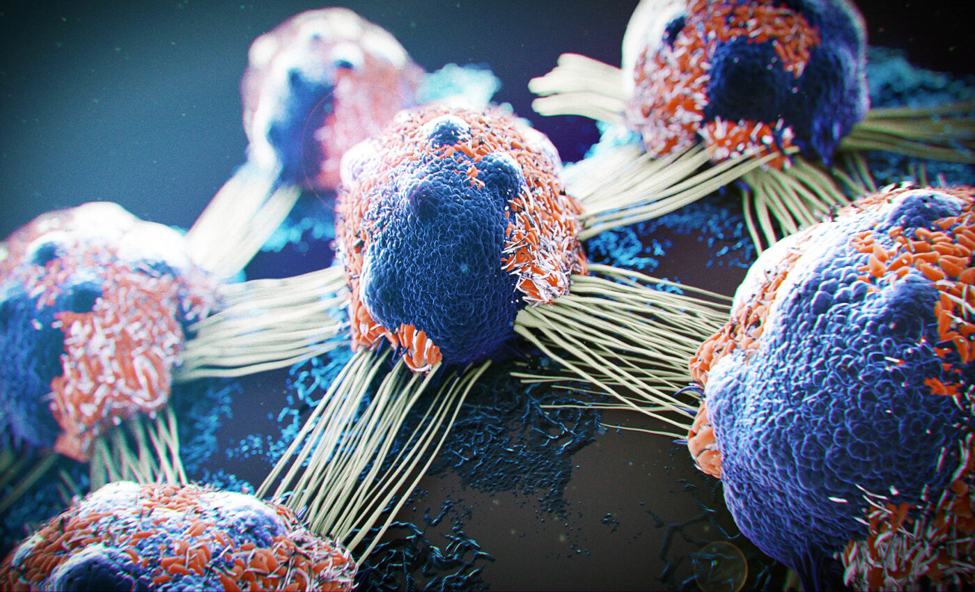 Cancer thrives on human stress as it spreads throughout the body