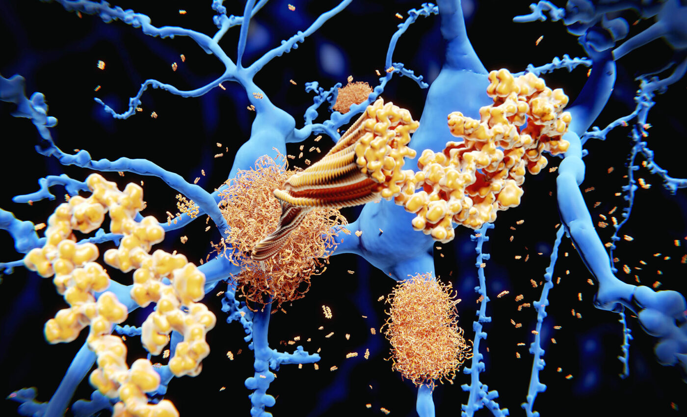 Scientists identify the earliest biomarker of Alzheimer's disease