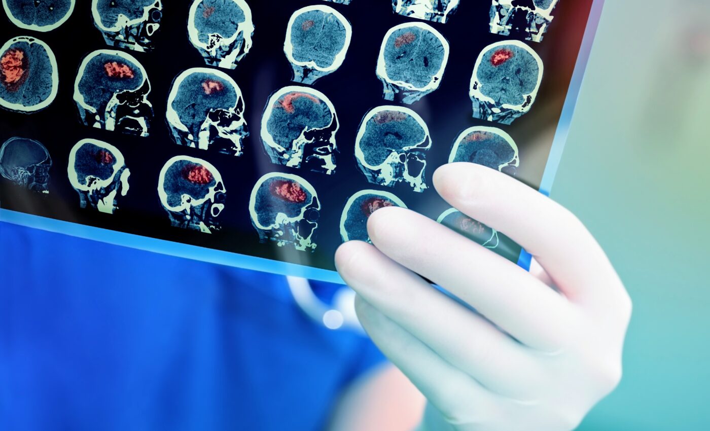 Dramatic temperature changes linked to half a million stroke deaths