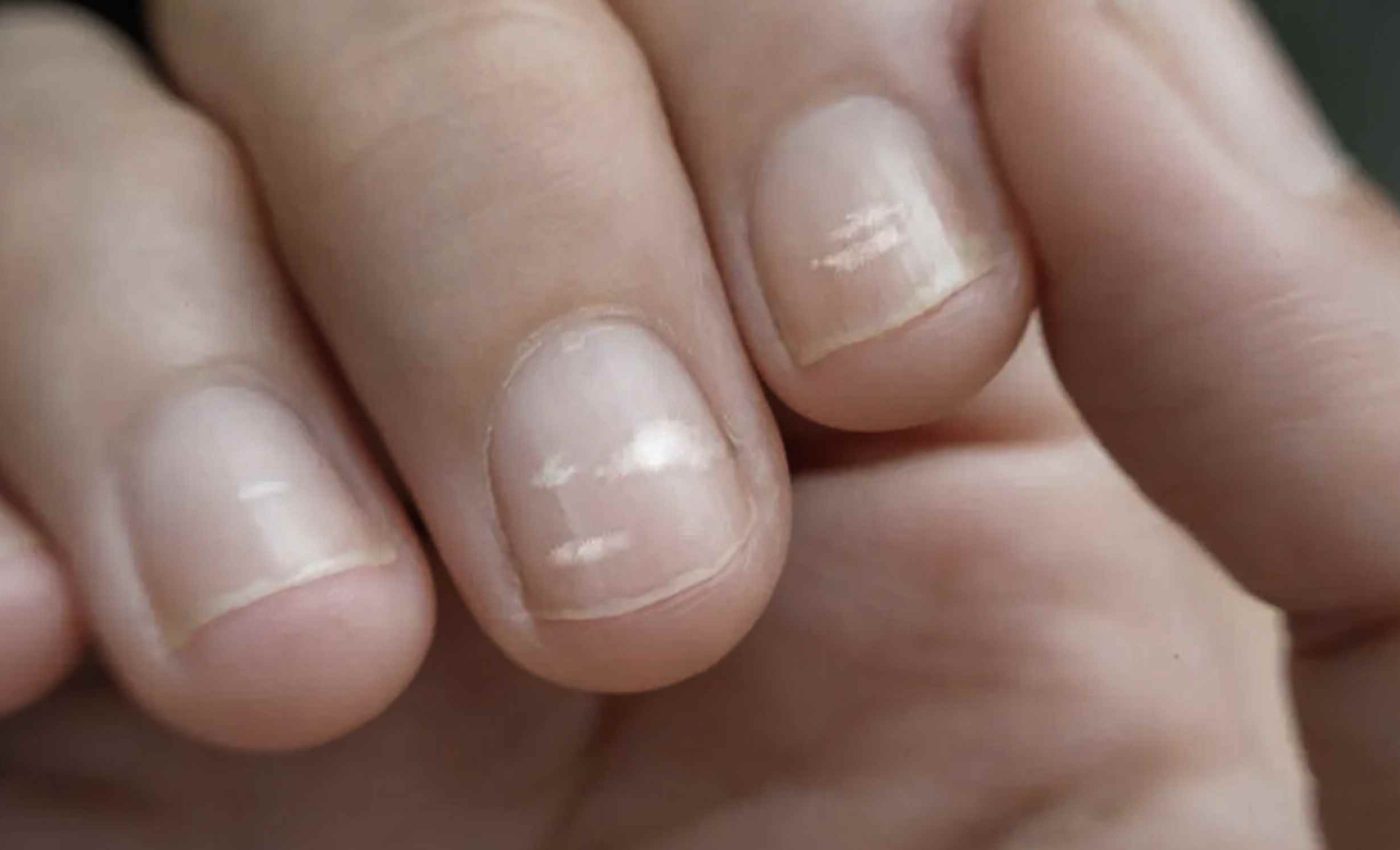 White stripes on your nails - what does that mean?