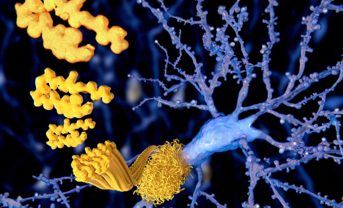 17-year-old man breaks the world record for early-onset Alzheimer's disease