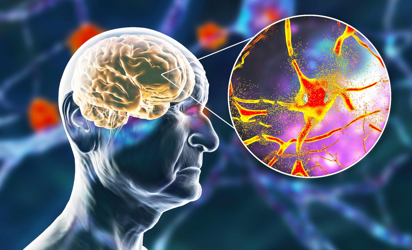 Doctors say this lifestyle choice is the biggest contributor to cognitive decline and dementia