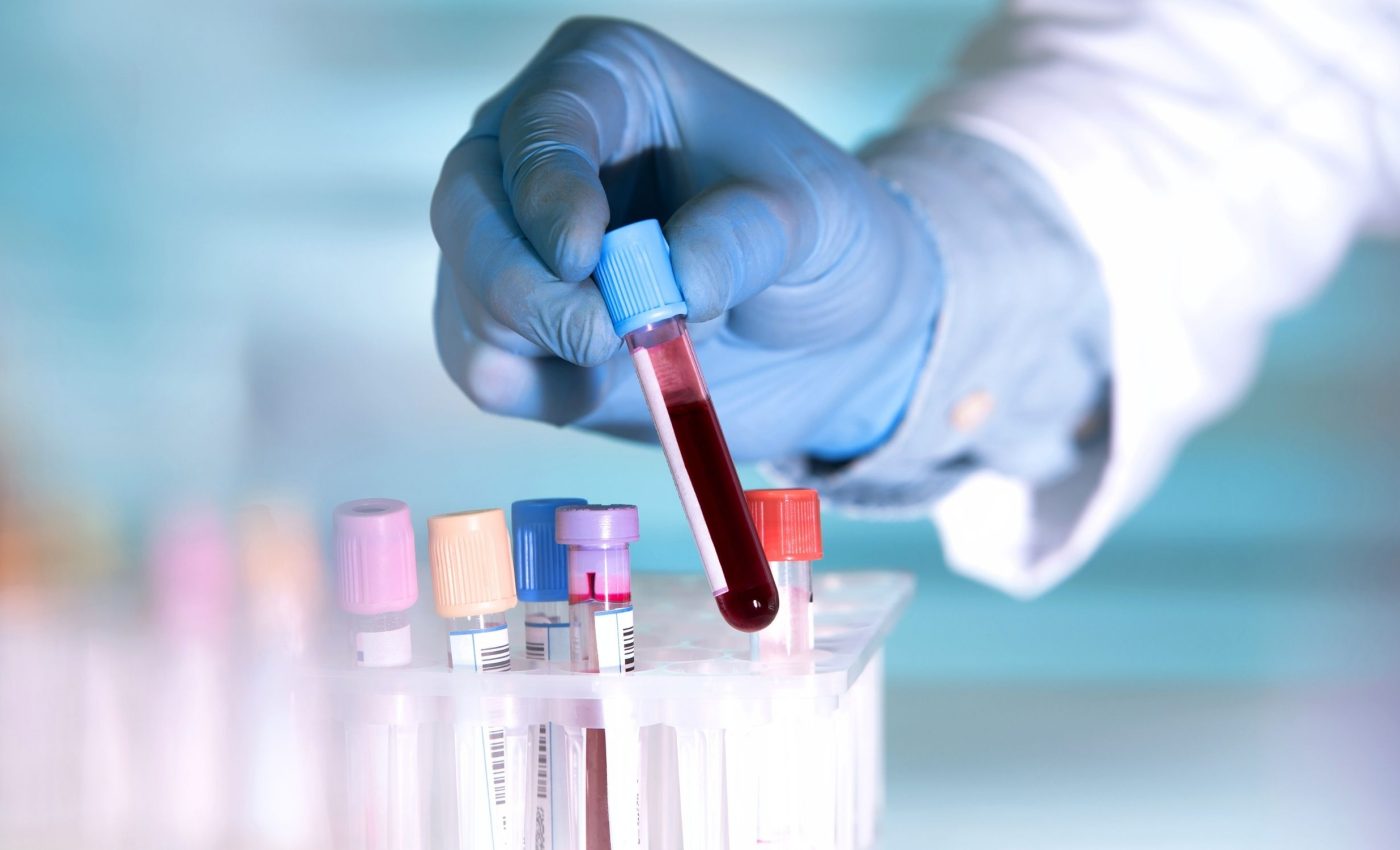 Simple blood test detects cancer up to 3 years before symptoms appear