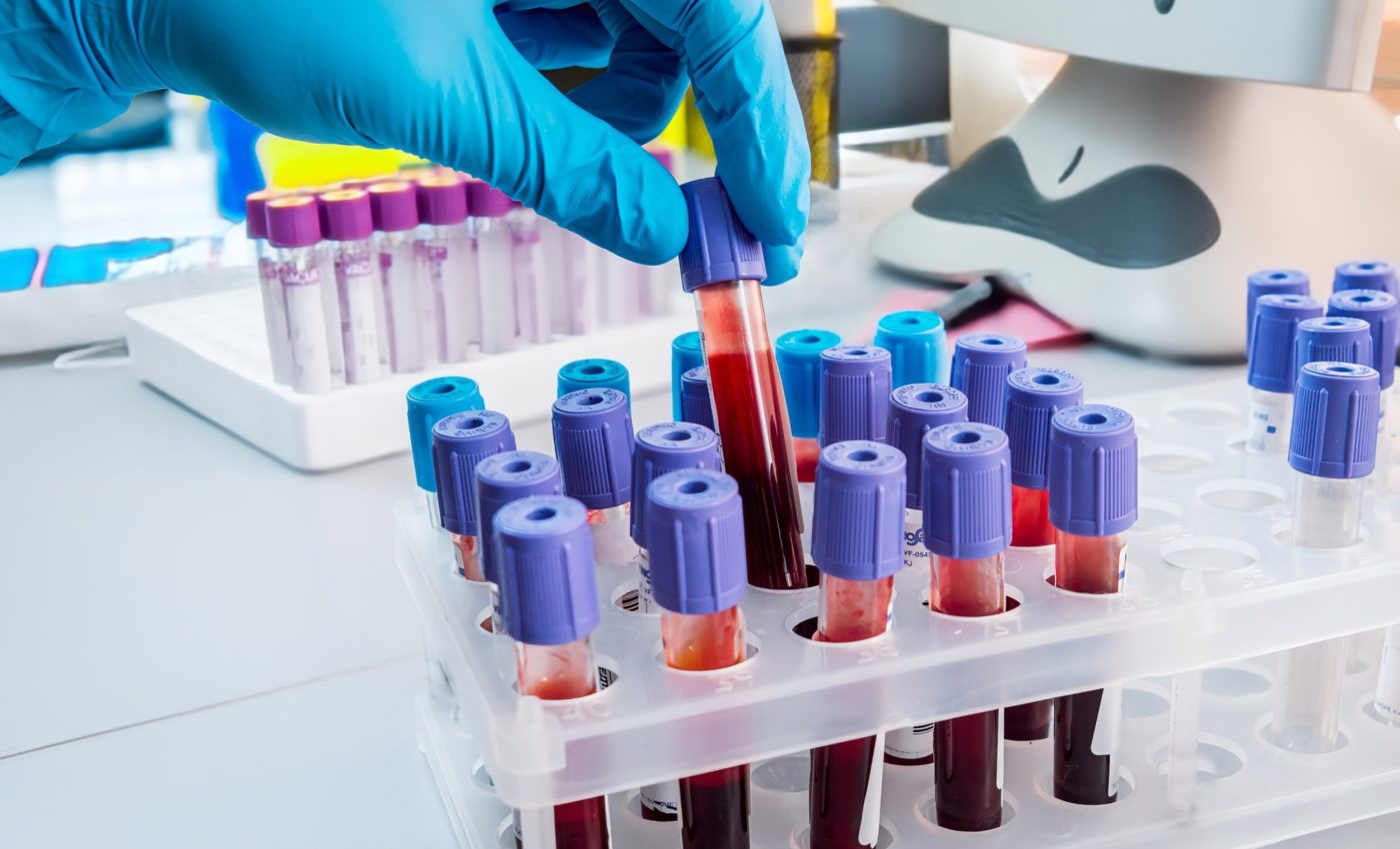 Scientists invent blood test that predicts cancer years before symptoms show