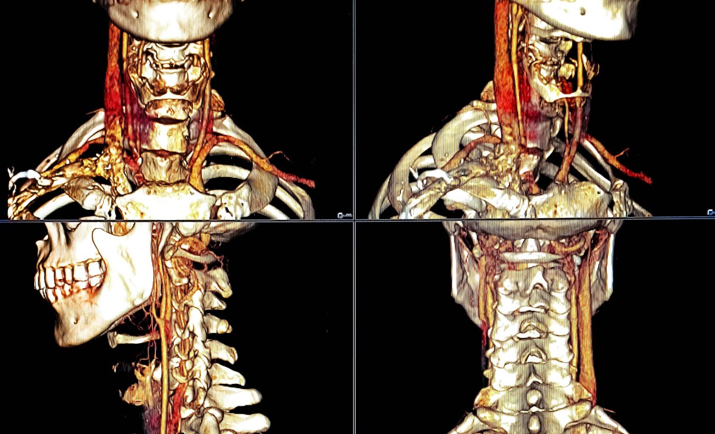 This little-known cause of strokes is breaking records, increasing 400% since 2005