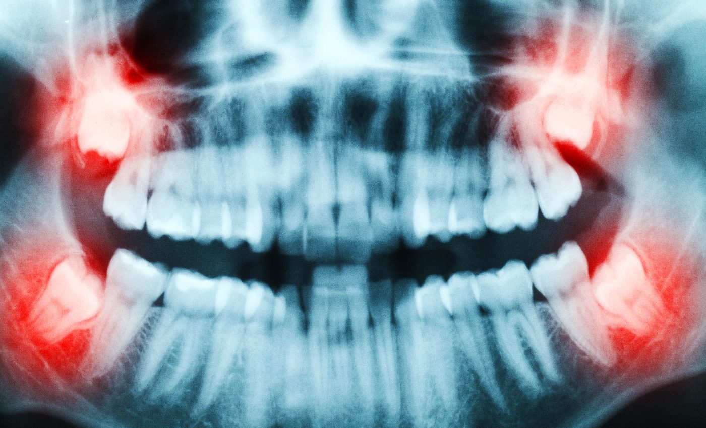 Stem cells from extracted wisdom teeth are like "medical gold," able to treat multiple diseases